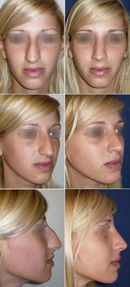 rinoplastia
